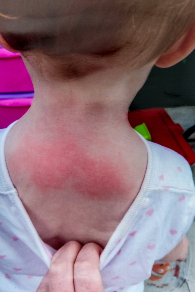  Tamzyn's skin turned bright red in a violent reaction to medication she was prescribed last June