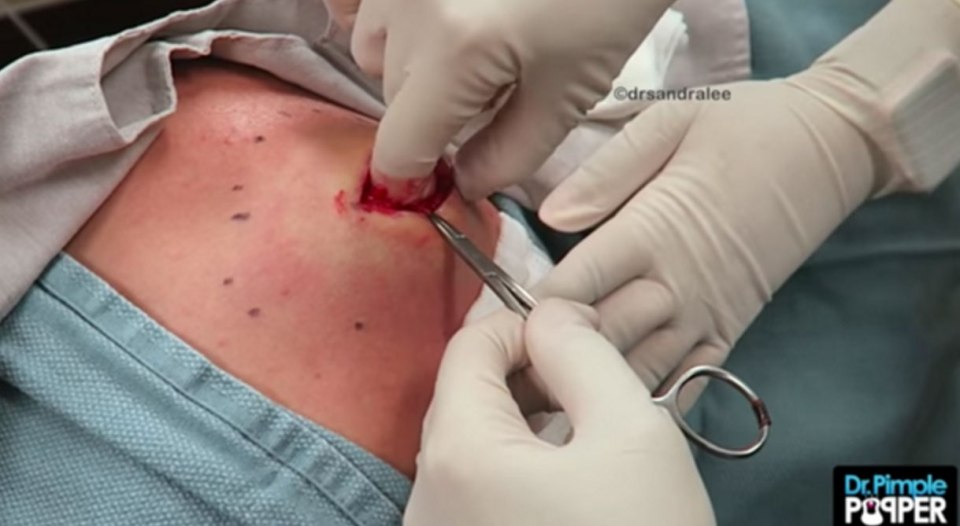 Dr Pimple Popper is back with probably her most disgusting video ever