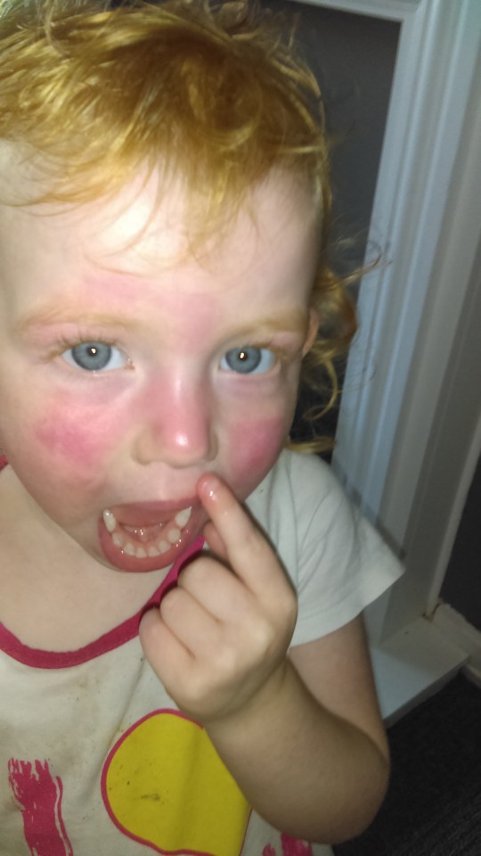 Martha was left with red and sore skin on her face after using the wipes