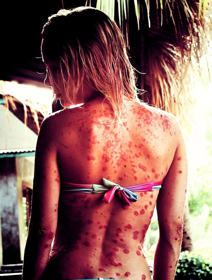  On a recent trip to Thailand, Giorgia was victim of an extreme psoriasis spell