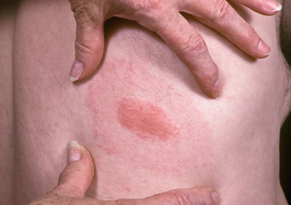 Not all people who are infected display the rash