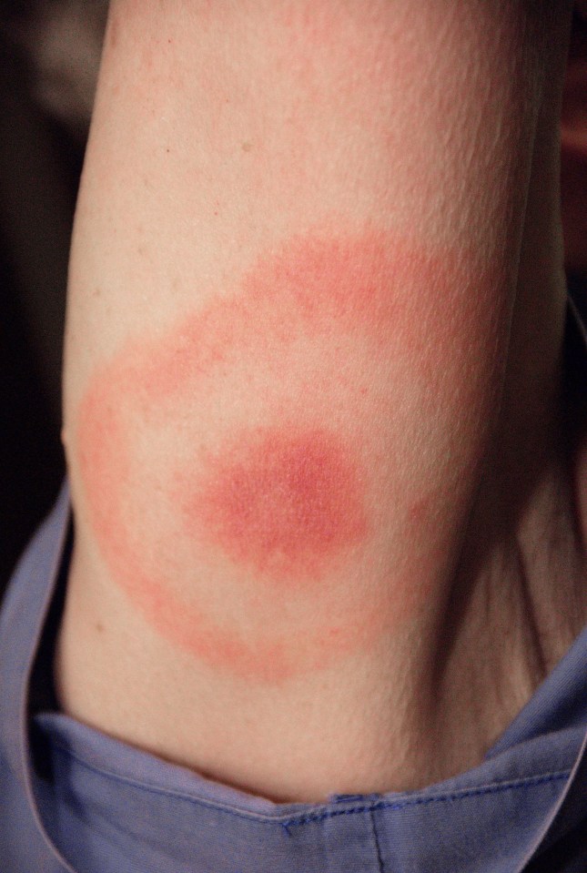  Once infected many people develop this distinctive rash