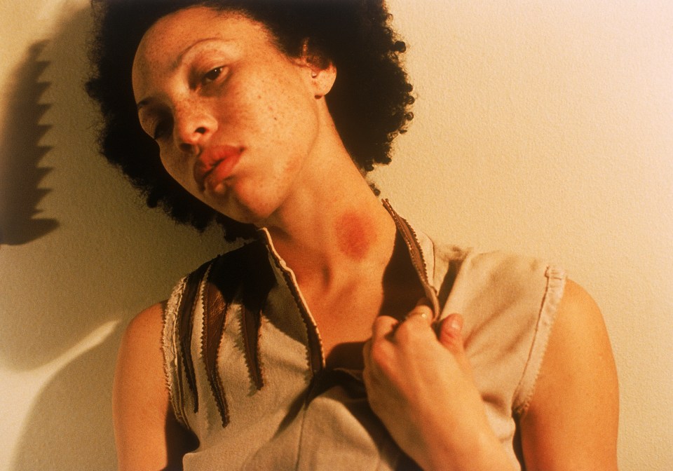 A woman with a hickey on her neck