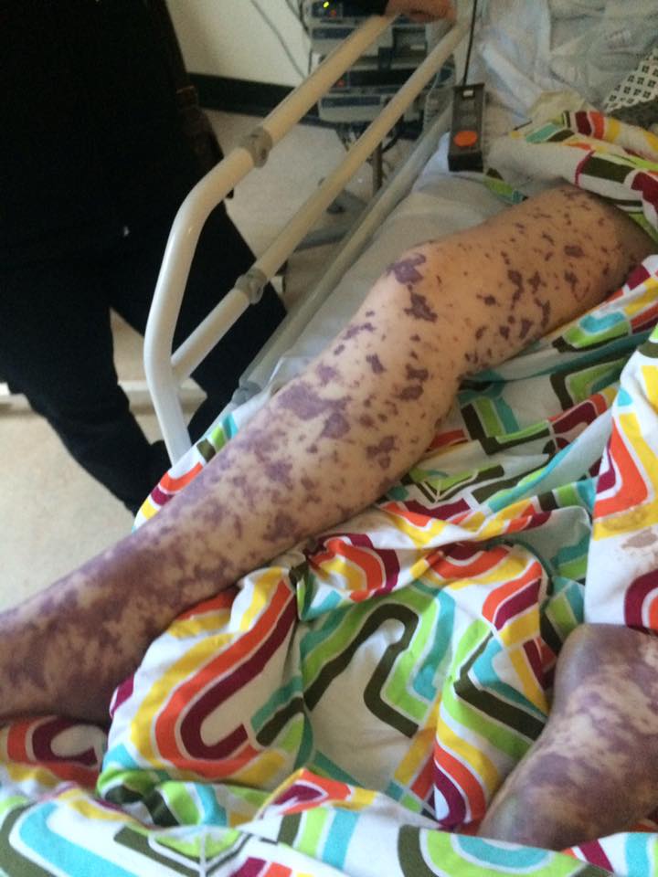 Her legs and feet are covered in the distinctive rash and swollen due to meningitis