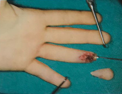 Another shot showed the wound left when the portion of her finger was torn off