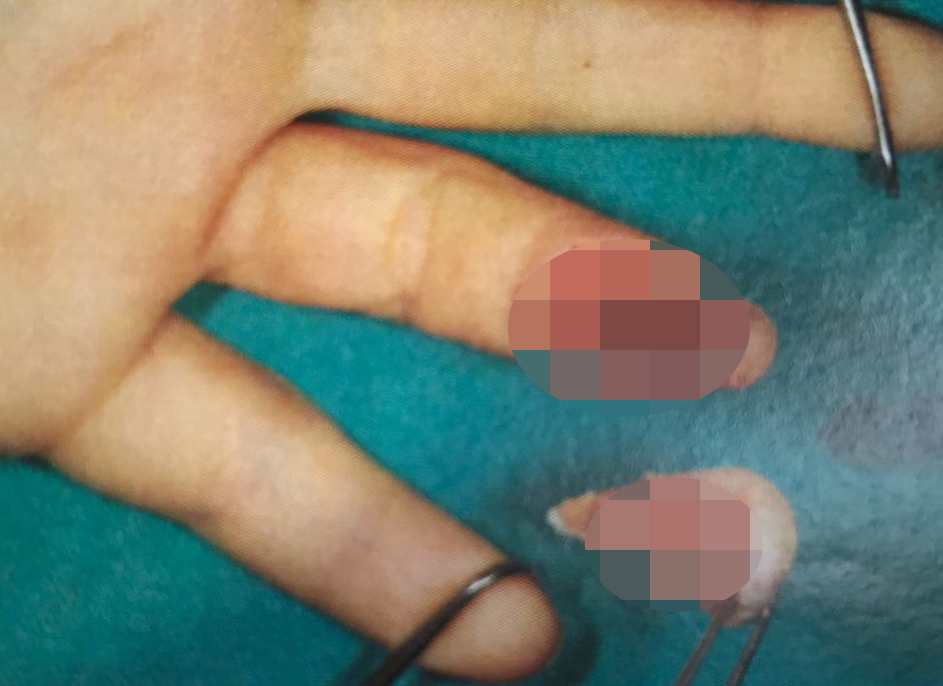 This image of the stars severed finger is too gruesome to publishing without blurring