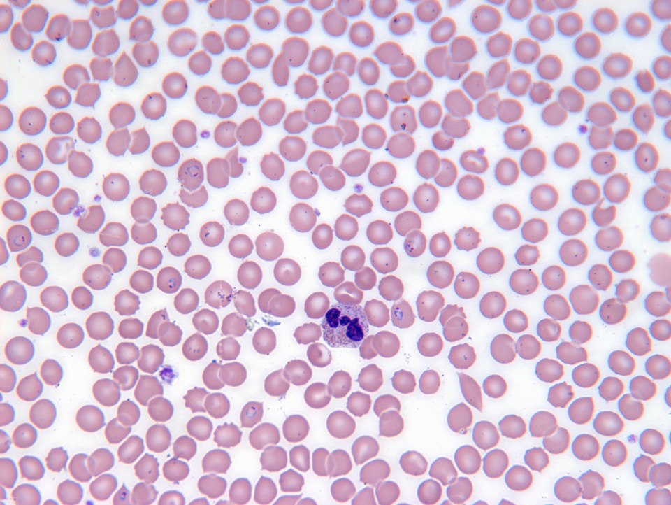 If successful, experts at Johns Hopkins University in Baltimore, say the technique could save an estimated 450,000 lives each year from malaria, pictured in the blood under the microscope, alone