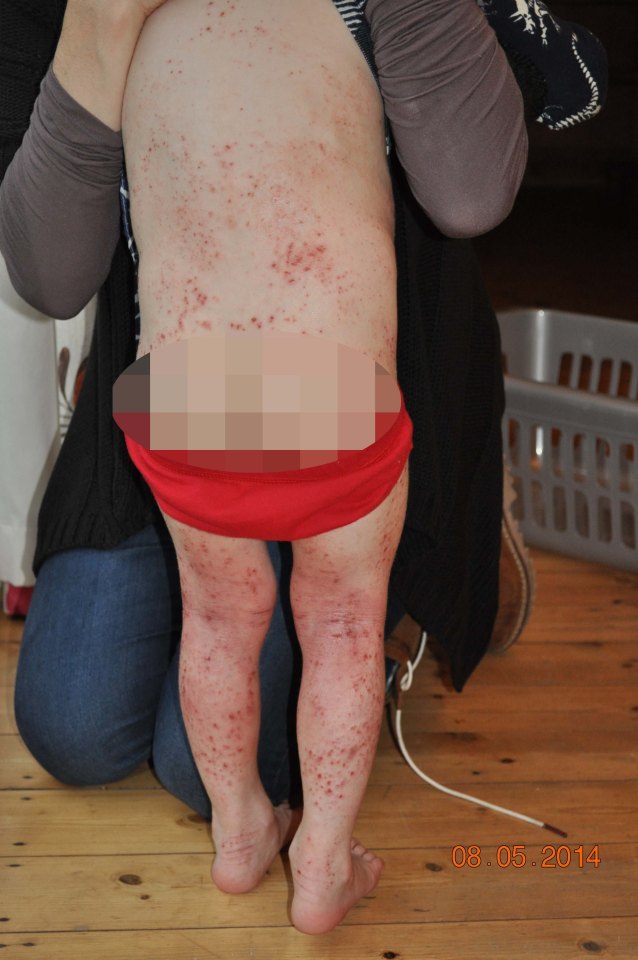 Owen's body was covered in sores, leaving deposits of dead skin and blood everywhere he went