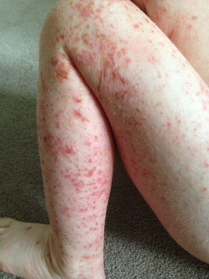 The little boy suffered from eczema for almost his whole life, with the skin condition worsening from when he was six weeks old