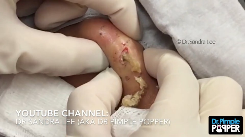 Dr Pimple Pooper cheek cyst