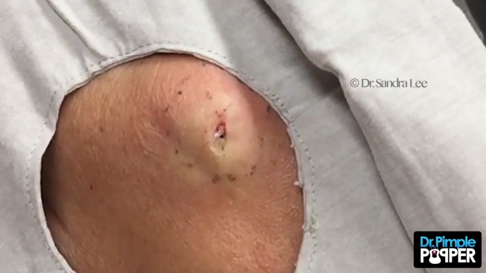 Dr Pimple Pooper cheek cyst