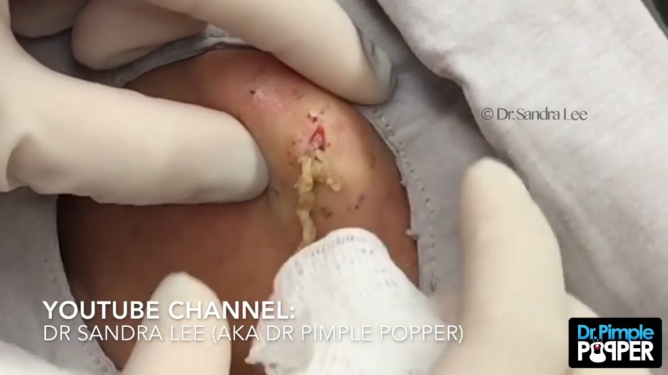 Dr Pimple Pooper cheek cyst