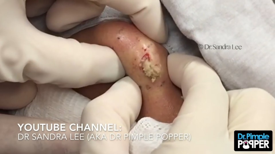 Dr Pimple Pooper cheek cyst