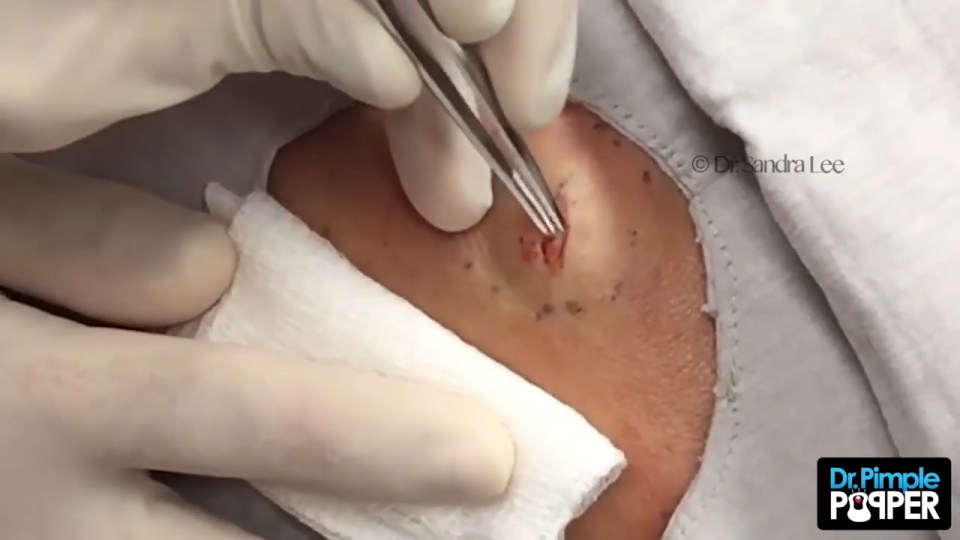 Dr Pimple Pooper cheek cyst