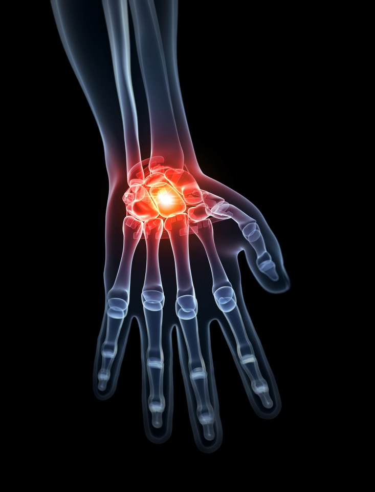  Arthritis is a common condition that causes pain and inflammation in a joint