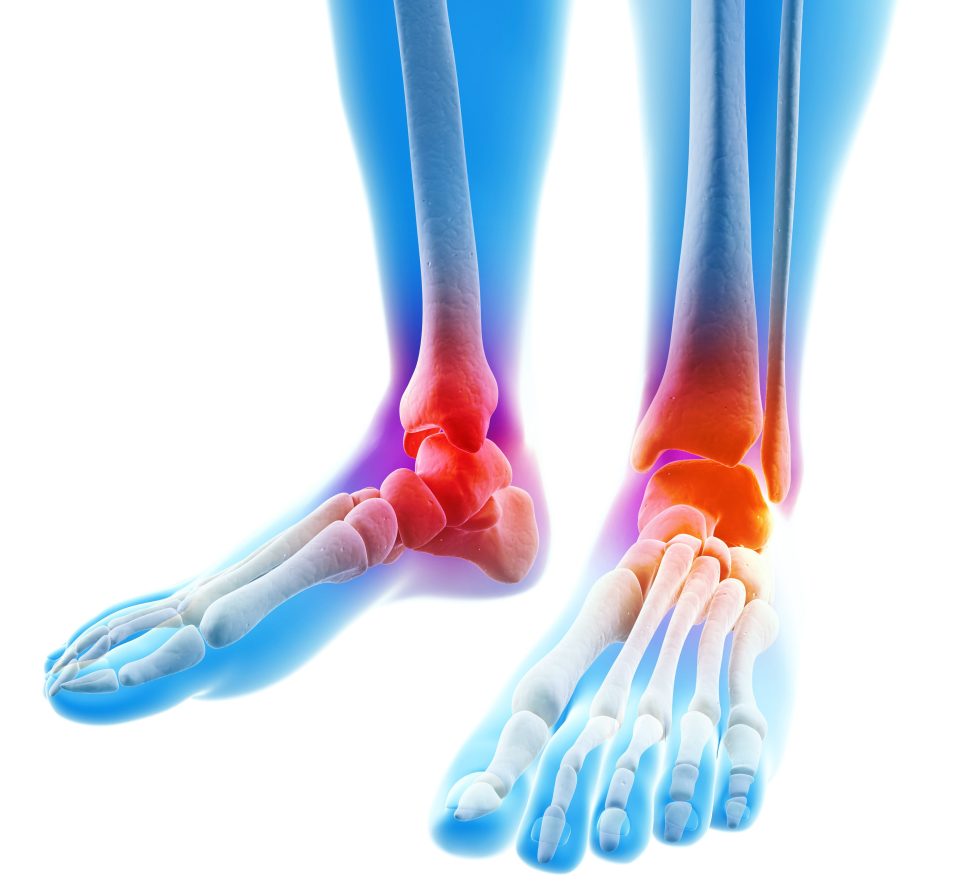  Swollen ankles can be a sign of oedema - a build-up of fluid