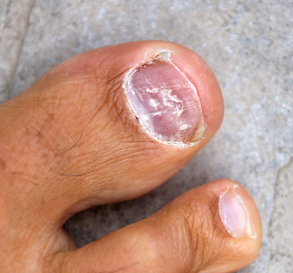  Pitted toenails can be a sign a person is suffering the common but chronic skin condition psoriasis