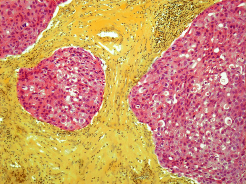  Signs of the disease, pictured under the microscope, include a change in size or shape and a redness or rash around the nipple area