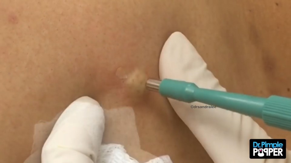 Dr Pimple Popper gets to work on an enormous cyst