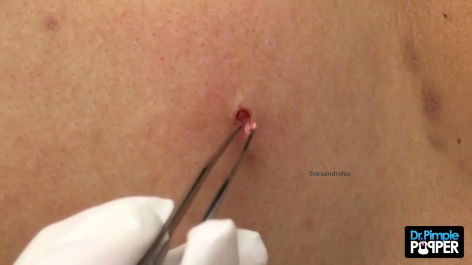 The man is left with a gaping hole which Dr Pimple Popper has to sew up