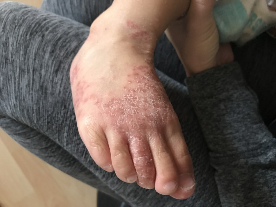 Aubrey Weatherall suffered a case of hand, foot and mouth disease