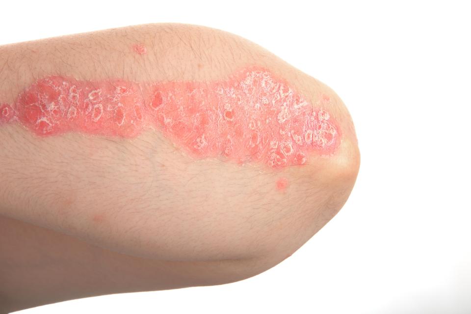  Eczema manifests as dry, scaly patches