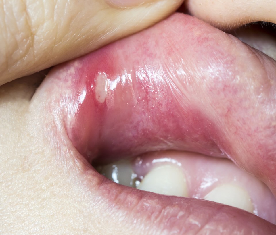  Mouth ulcers can be very painful and uncomfortable - here are some of the best ways to get rid of one using things from home