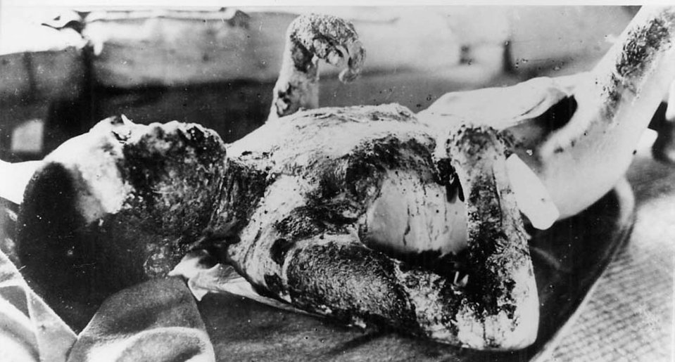  A nuclear bomb victim lies in quarantine on the island of Ninoshima next to Hiroshima