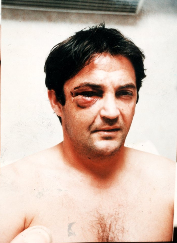 Mabbutt showing his injury after surgery