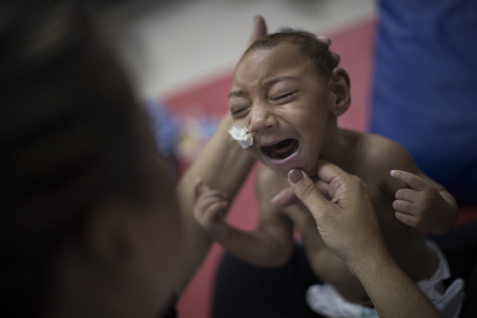  Zika infections in pregnant women have been shown to cause microcephaly - a severe birth defect in which the head and brain are undersized - as well as other brain abnormalities