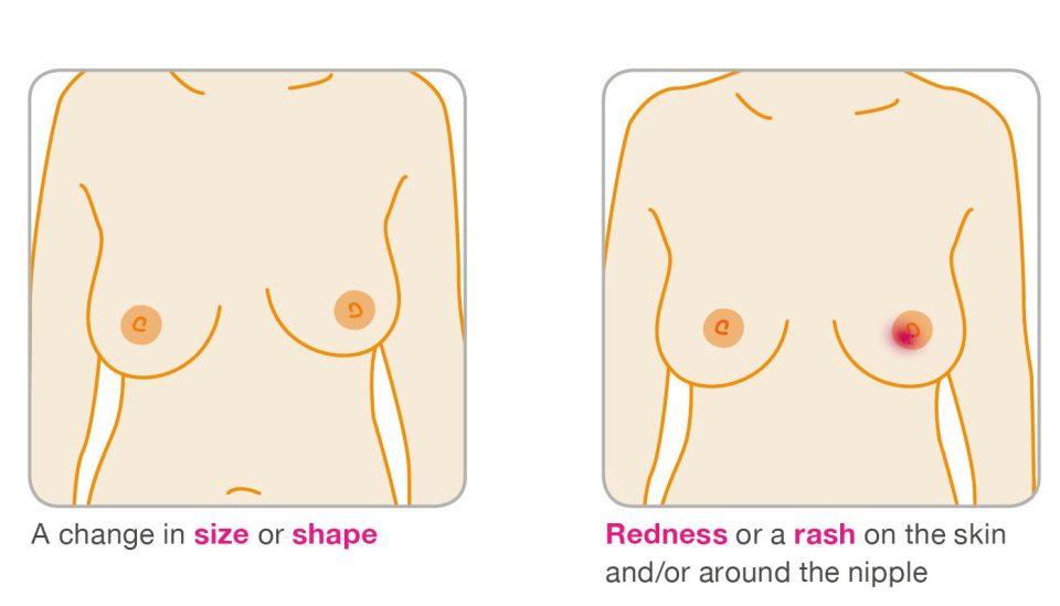  Always check your breasts regularly to know whether change in size or shape is normal for you