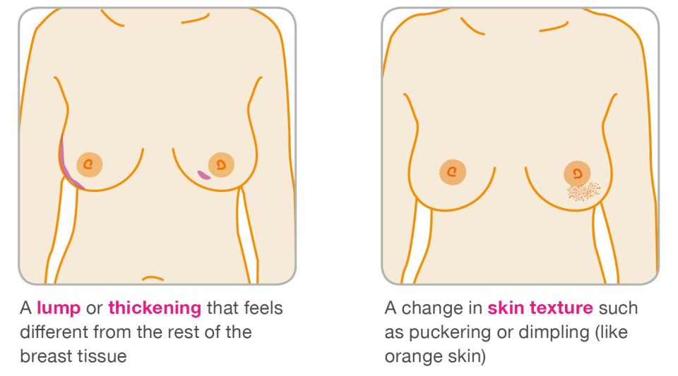  Any lumps or change in breast texture should be checked as soon as possible by a doctor