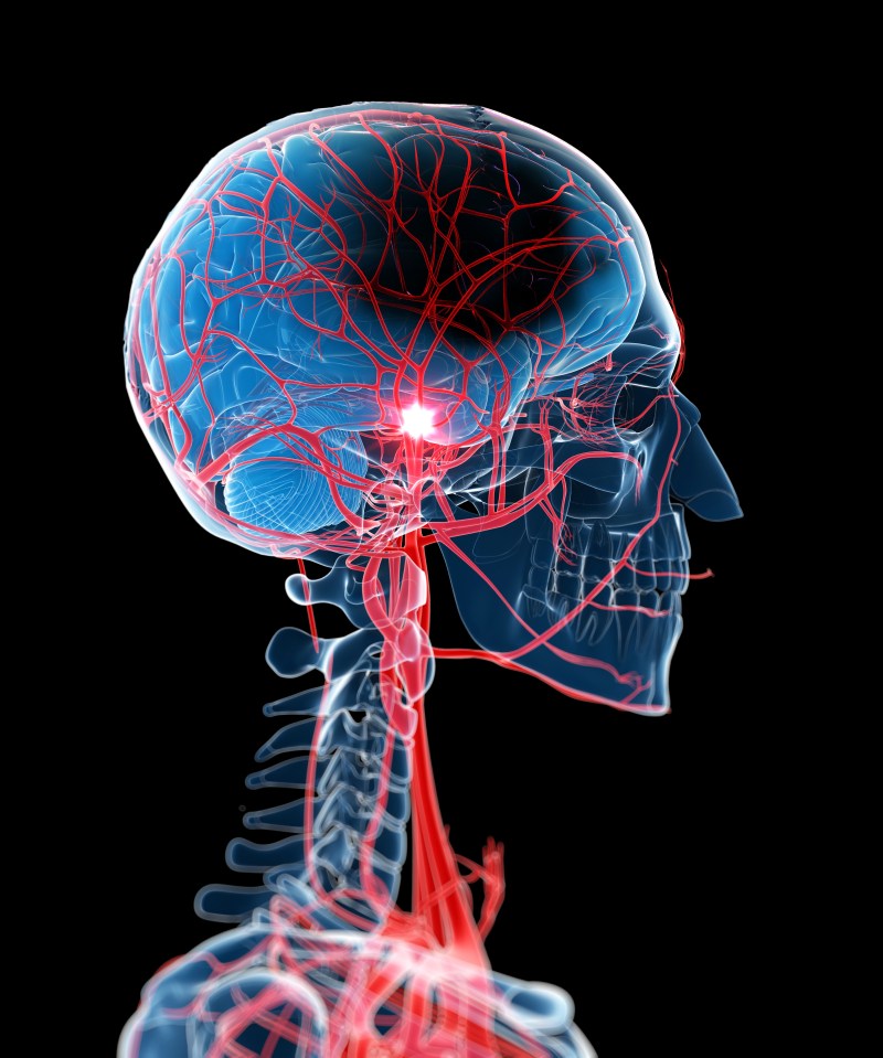 Experts followed 244,000 middle-aged men and women over a six year period. Nearly 10,000 went on to suffer a stroke