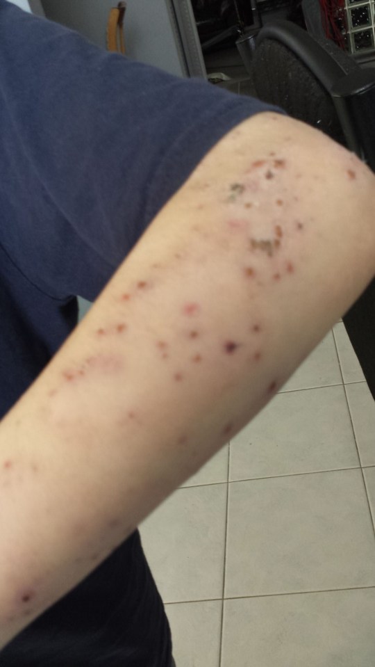 JEANS AND BATTERIES MAKE MY SKIN FALL OFF: BRAVE TEENAGER IS ALLERGIC TO MODERN LIFE