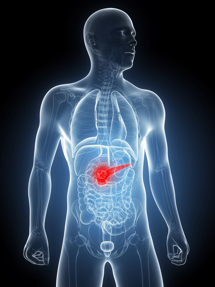  Pancreatic cancer patients could live five years longer with new combination of drugs