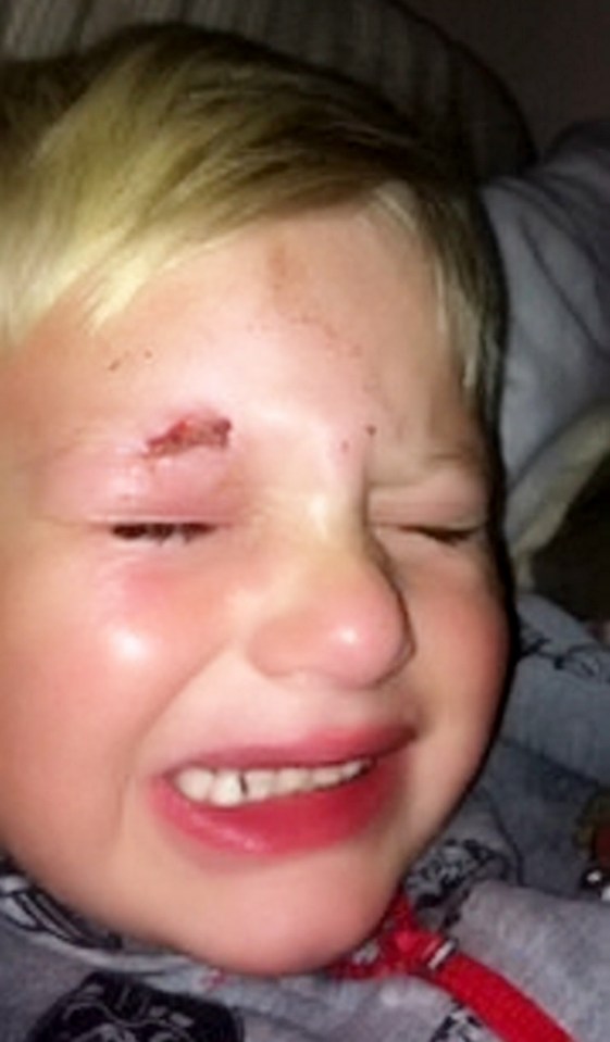  Little Jay Watson, four, screamed in terror as a doctor accidentally glued his eye shut