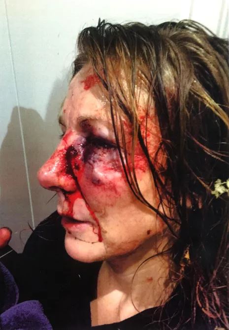  Philippa May, 43, released pictures of her horrific injuries in a bid to help track her attacker