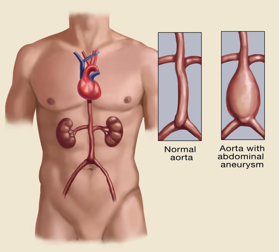 Appearance of a normal abdominal aorta and one with abdominal aortic aneurysm