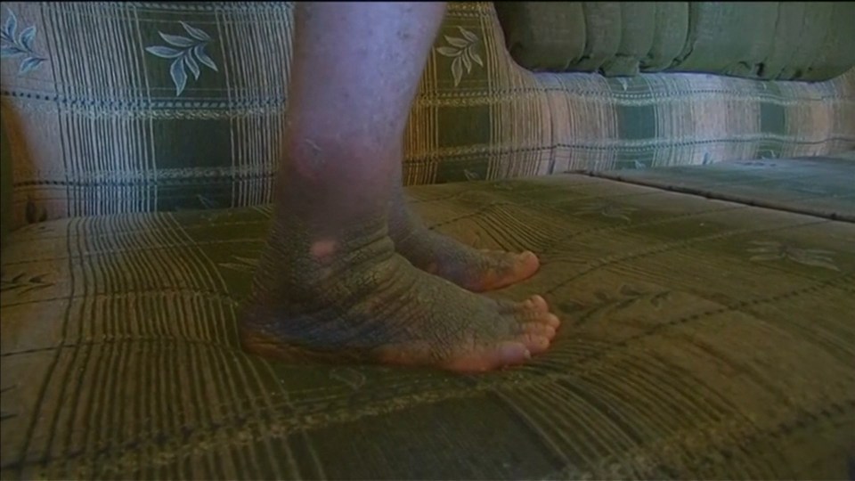 The skin on her feet are blistered by the gruesome weapon allegedly used by ISIS 