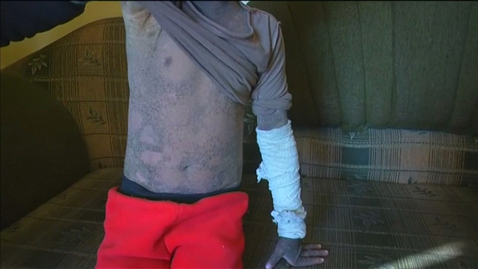 This child's skin has been painfully burned by a chemical attack