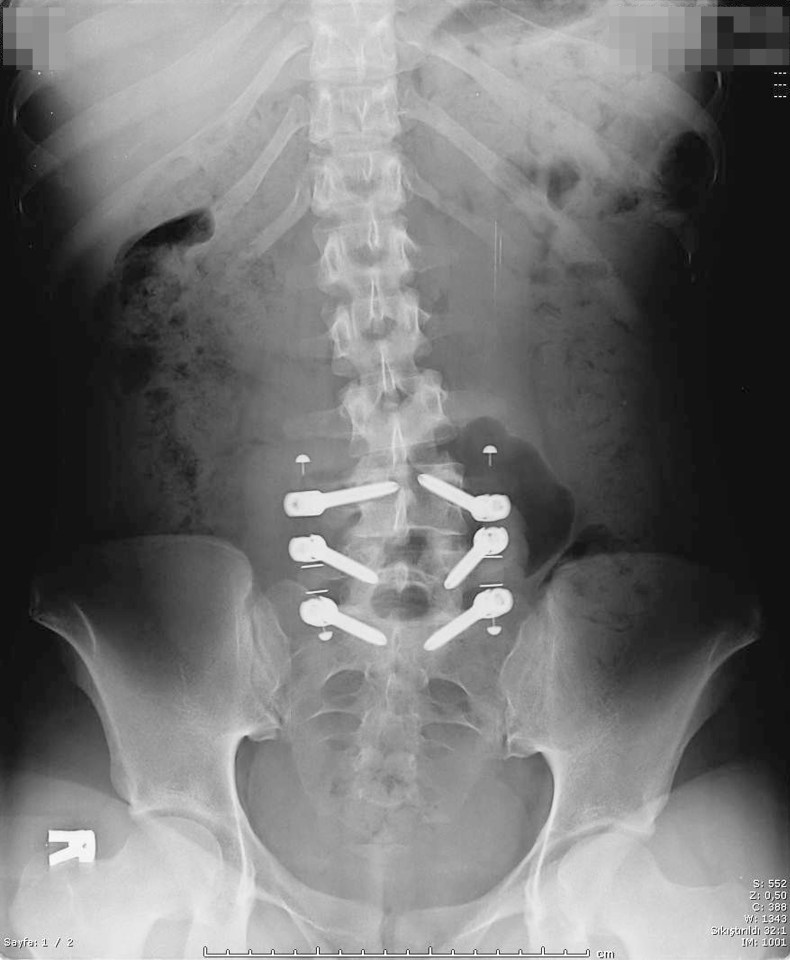 Six pins were inserted into Ece's spine to straighten it out