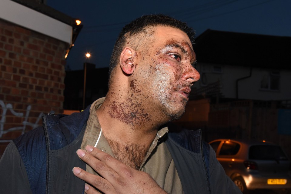  A passerby helped to spray water over the acid, action that Imran believes saved him from even worse injuries