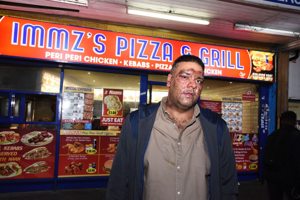  Imran Khan was left with serious burns to his face after being attacked by teenage thugs