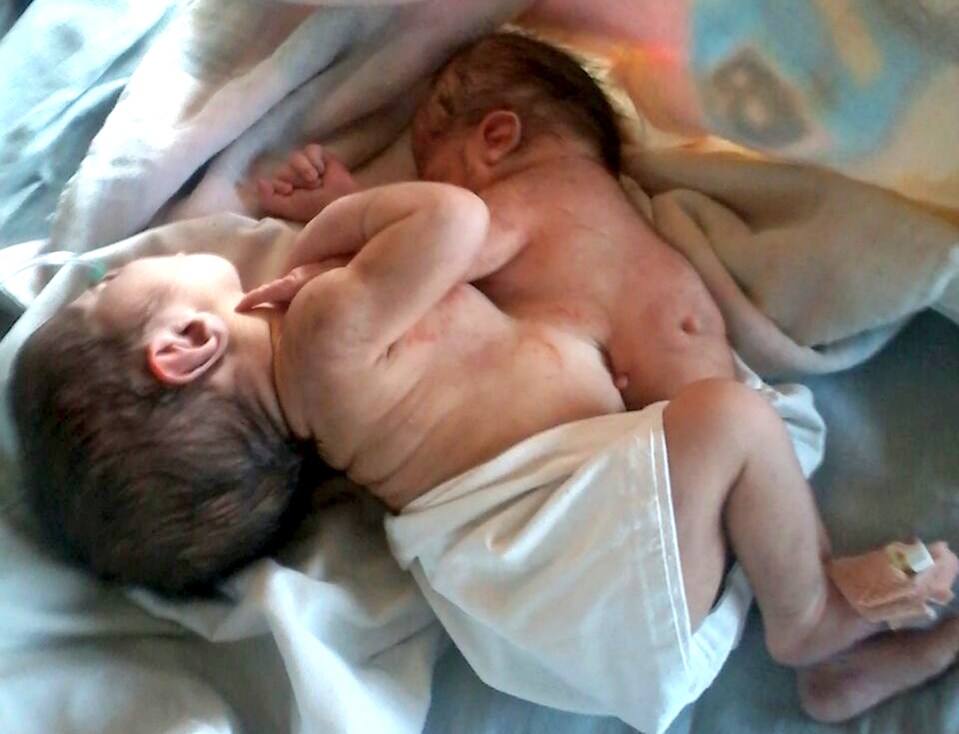  A woman in India gave birth to a baby boy with the head and arms of his parasitic twin still attached to his chest