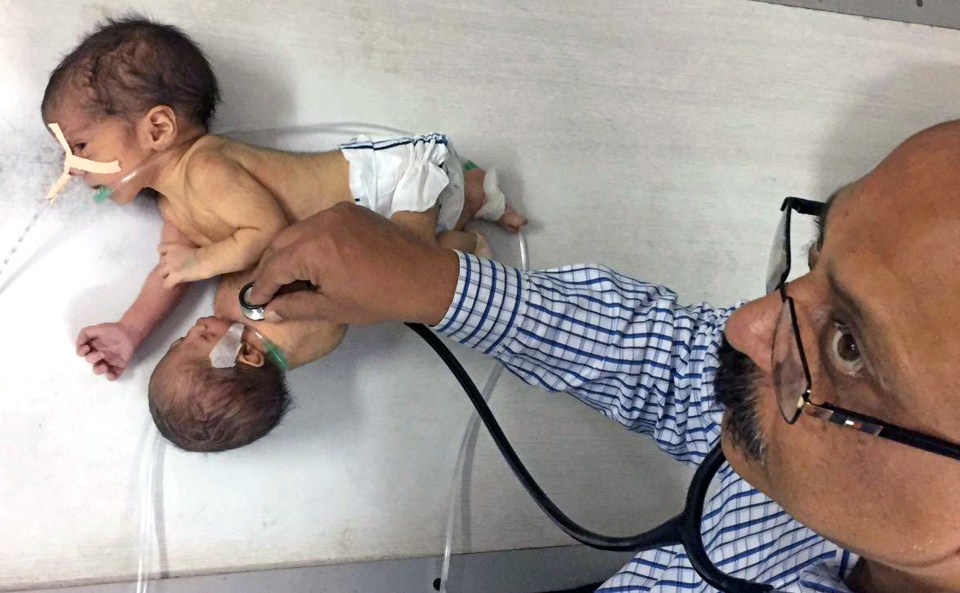  Doctors believe they will be able to remove the parasitic twin from the baby boy, without compromising his condition