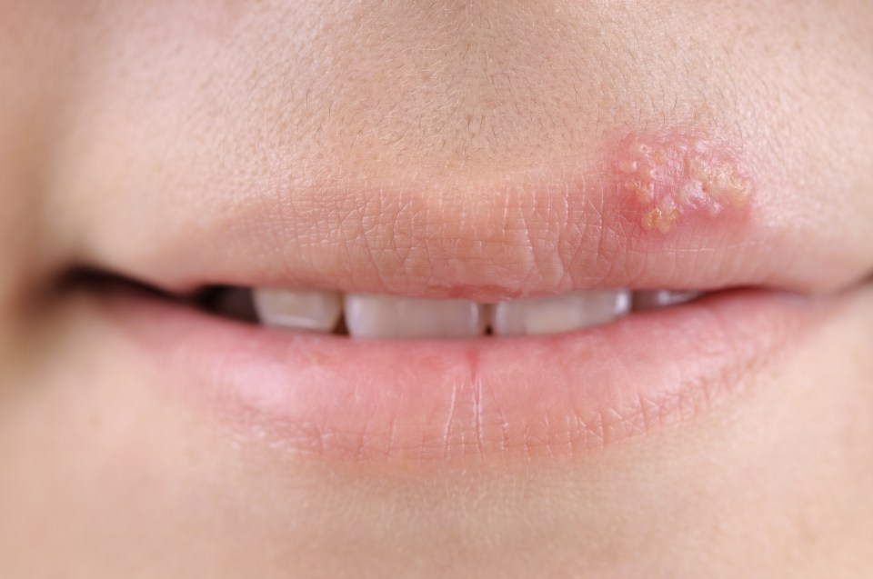 Neonatal herpes can be caused by kissing a baby while you have a cold sore