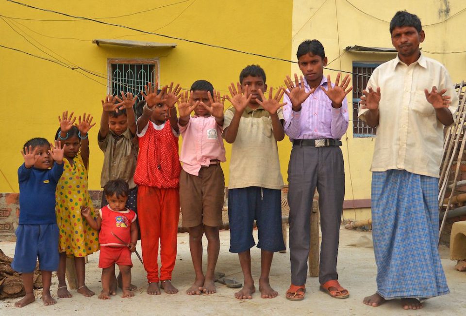  The Choudhary clan have 12 fingers and 12 toes each