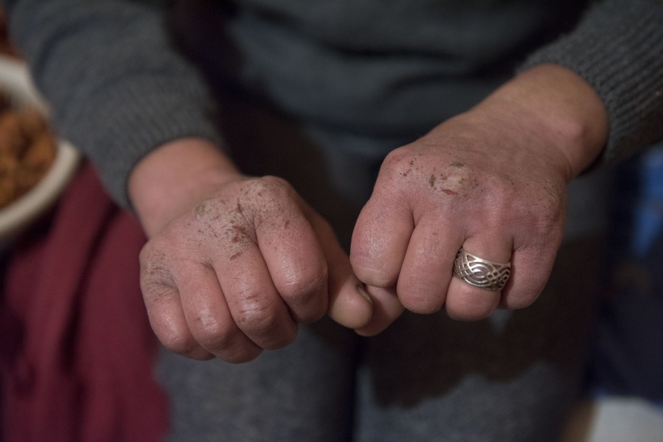 Felicia, a heavy smoker, has callouses on her fingers after working 13 hours a day for two years