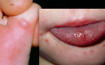 A rash that appears on the hands or feet, along with ulcers in the mouth is probably a sign that your baby is suffering hand, foot and mouth