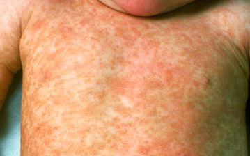 Hives is a raised, red and very itchy rash triggered by an allergic reaction